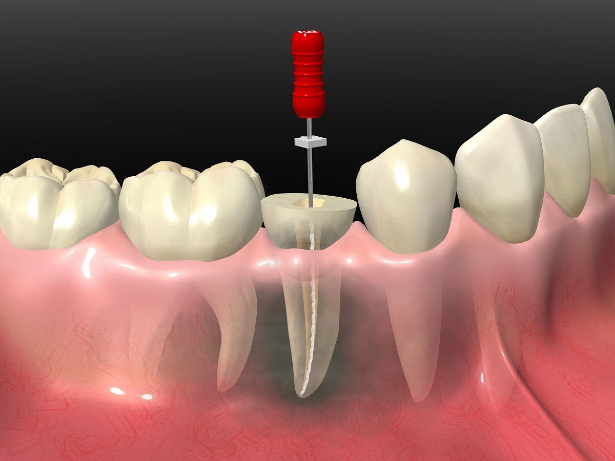 『歯を残す治療』根管治療