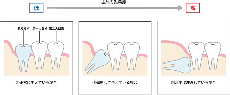 親知らず【生え方の種類】と【痛む原因】